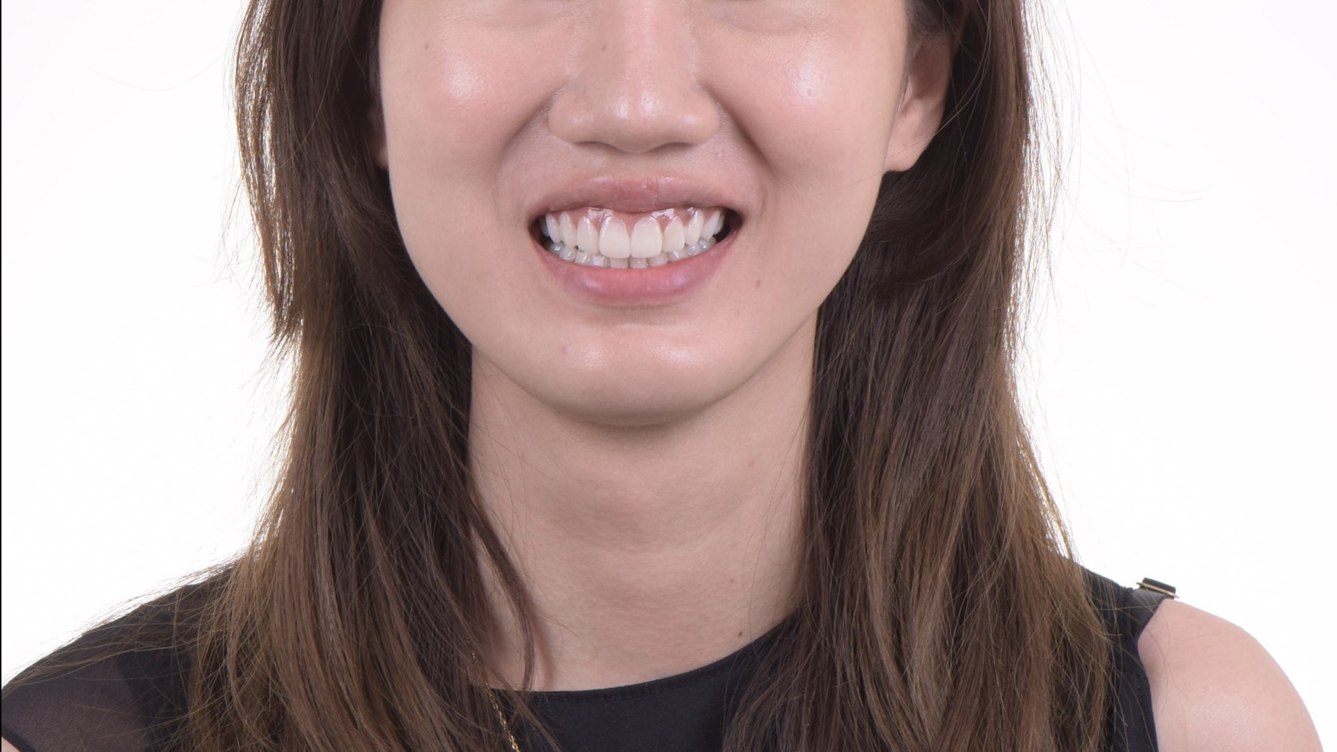 數位微笑模擬（digital smile design)