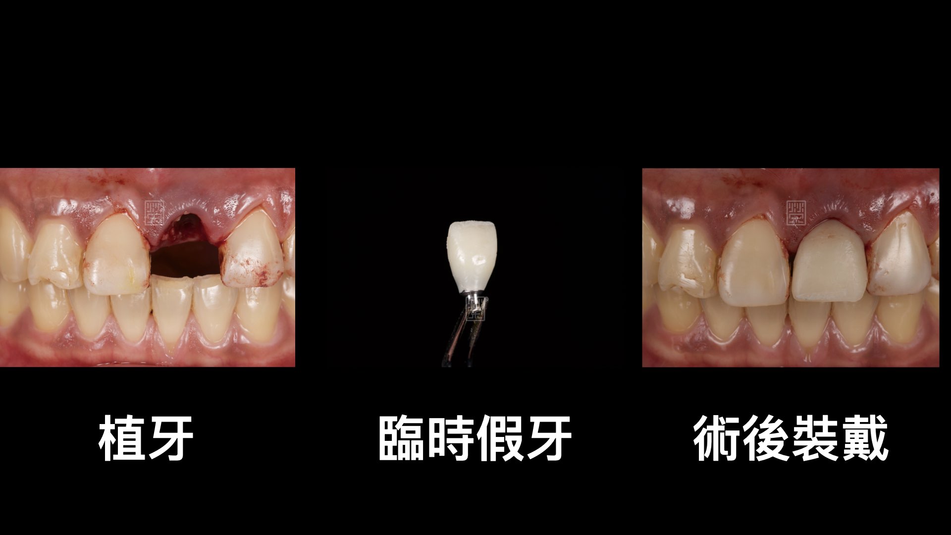牙齒拔除，臨時假牙立即製作
