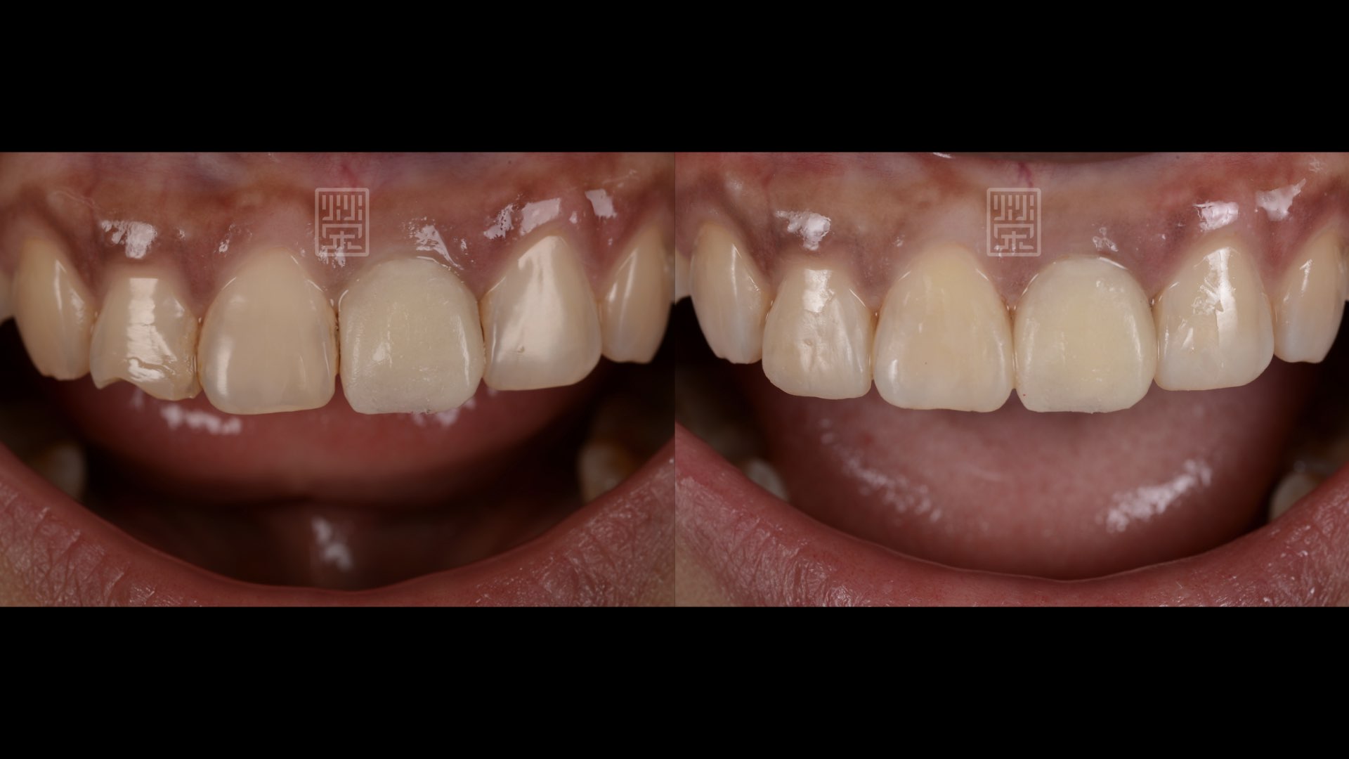 重新修復臨牙蛀牙與型態