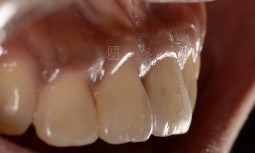 我咬了一口排骨，牙齒『啪』ㄧ聲，就鬆掉了————植牙修復