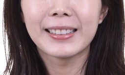 我的牙齒怎麼洗都是黃黃的————全口美白貼片