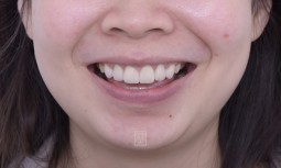 我的牙齒有點小------全瓷冠貼片合併牙齦整形術
