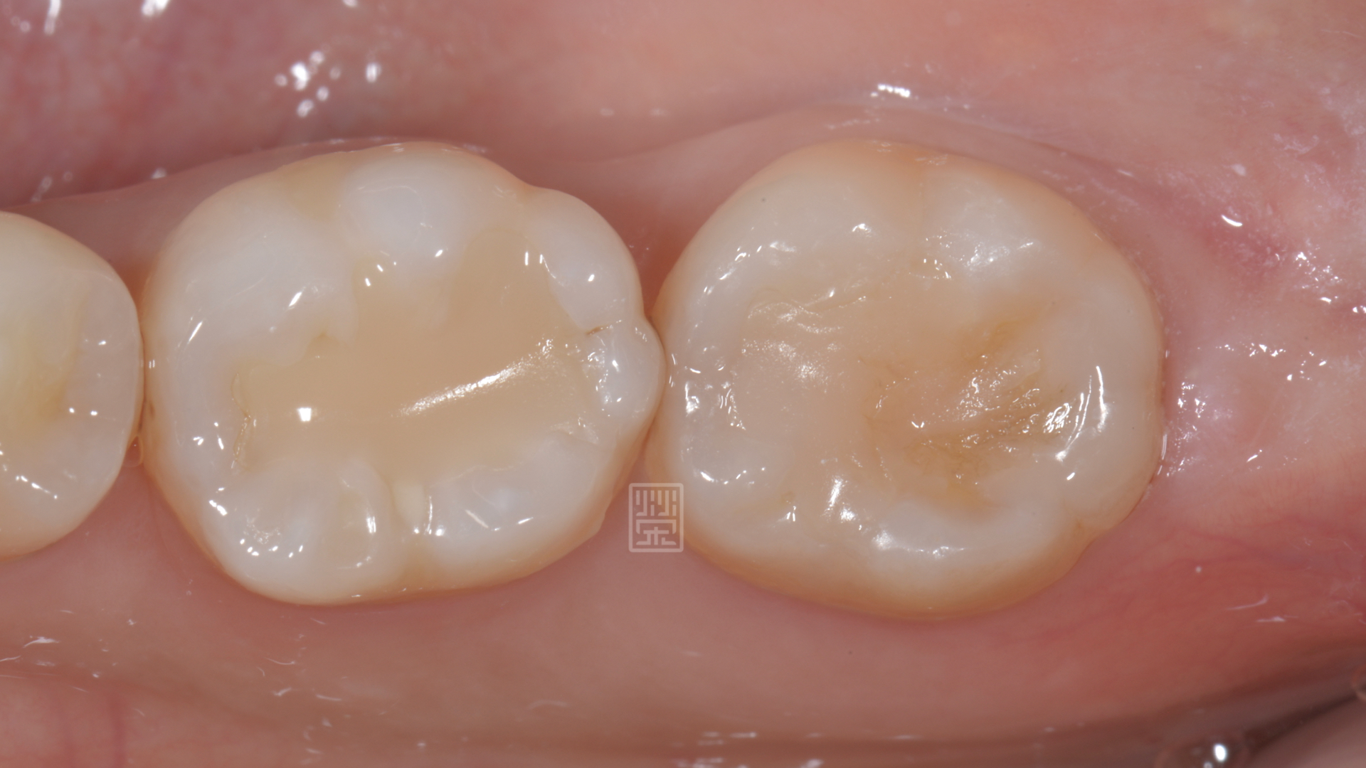 牙齒最後有填補