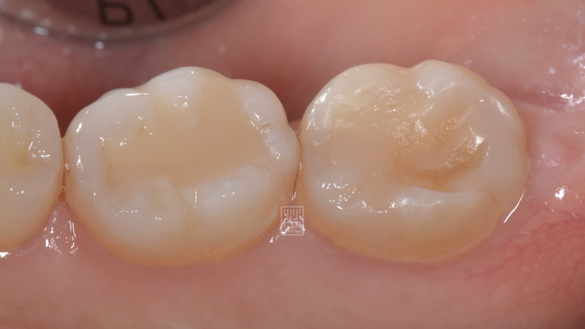 大臼齒整個被磨的凹下去