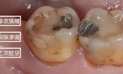 我的牙齒好像乞丐裝，縫縫補補好多次---多次填補再蛀牙