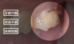 上顎大臼齒牙齒外翻，牙刷不好放，很難清潔---全瓷嵌體治療