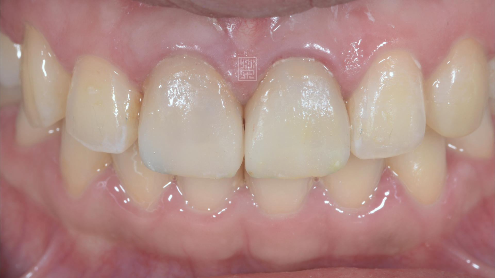 換上新的臨時假牙