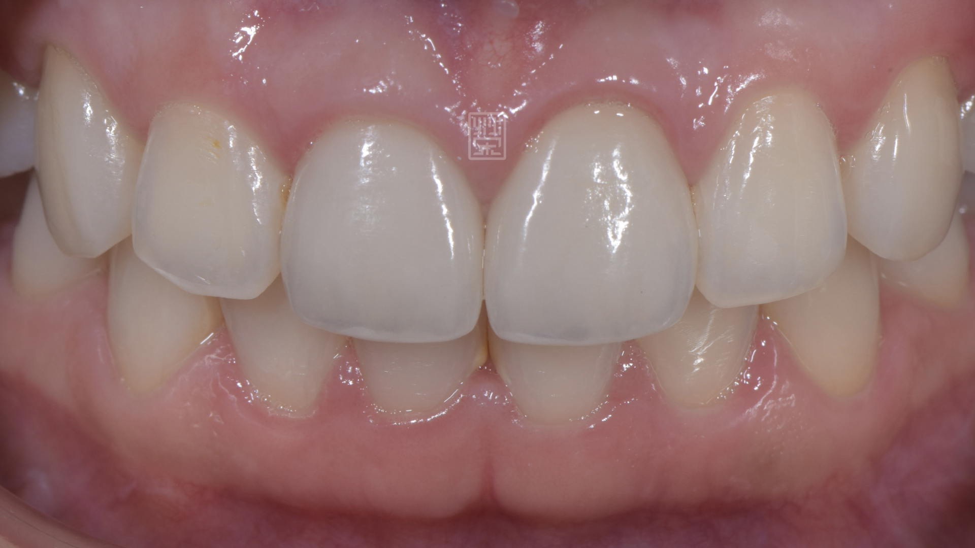 美白、全瓷冠完成