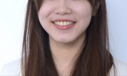 牙齒門牙好長，像小老鼠一樣，要怎麼辦呢？------全瓷貼片