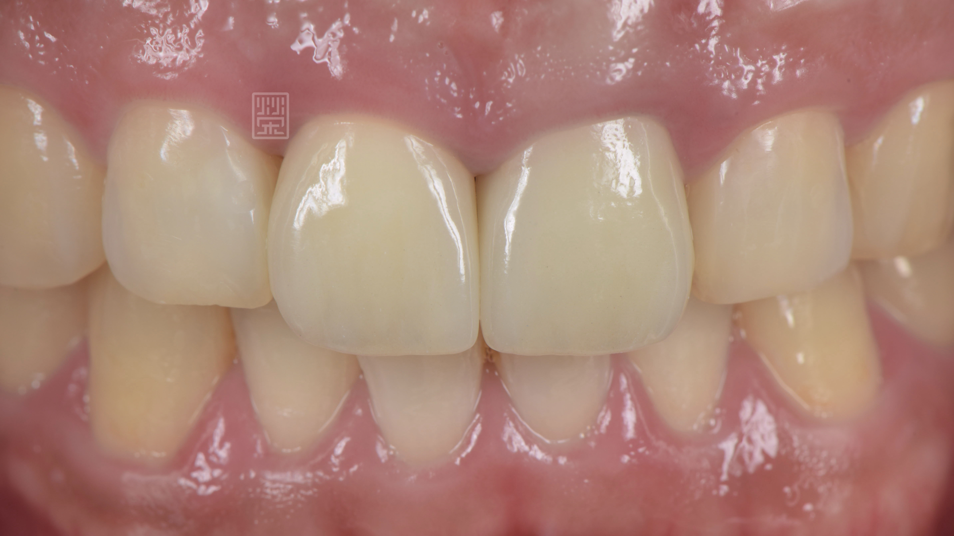 植牙全瓷冠完成