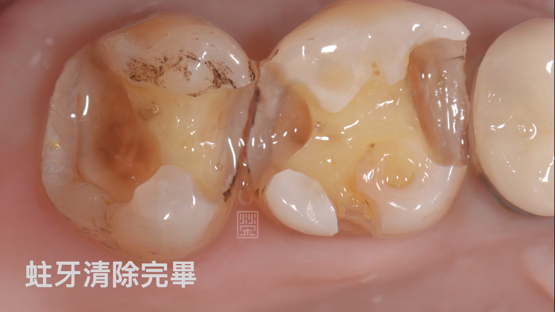 清除後齒質嚴重喪失