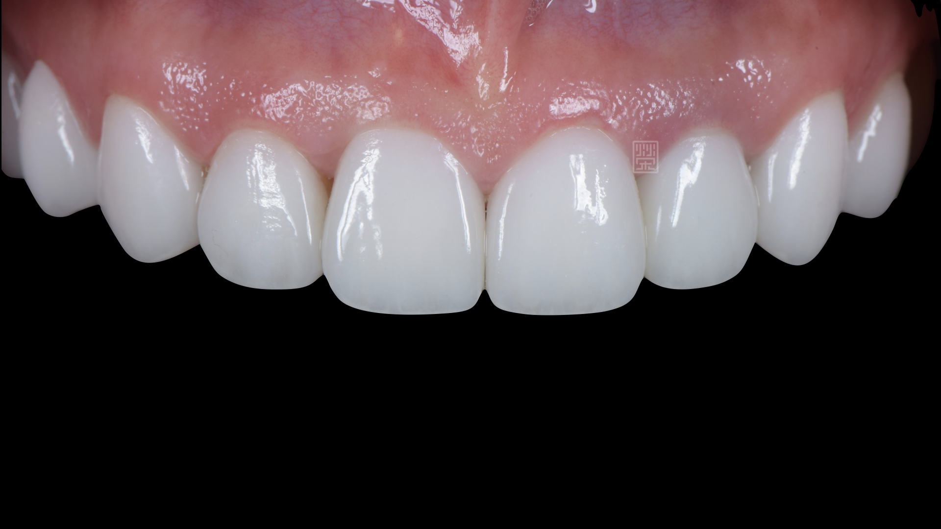 全瓷冠、貼片修復