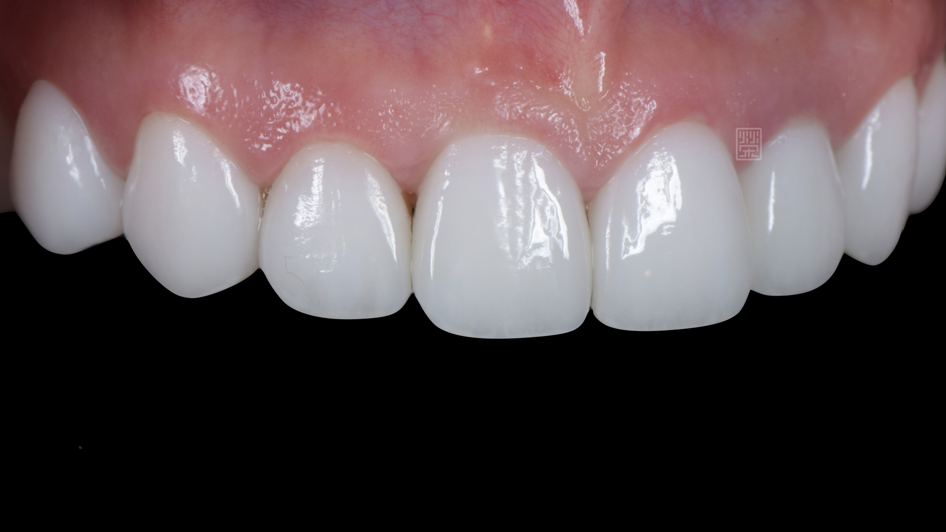 全瓷冠、貼片修復