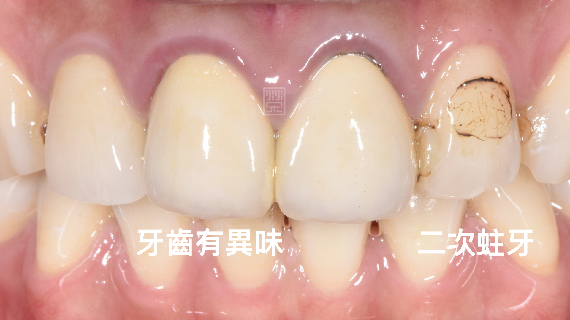 門牙舊假牙有異味