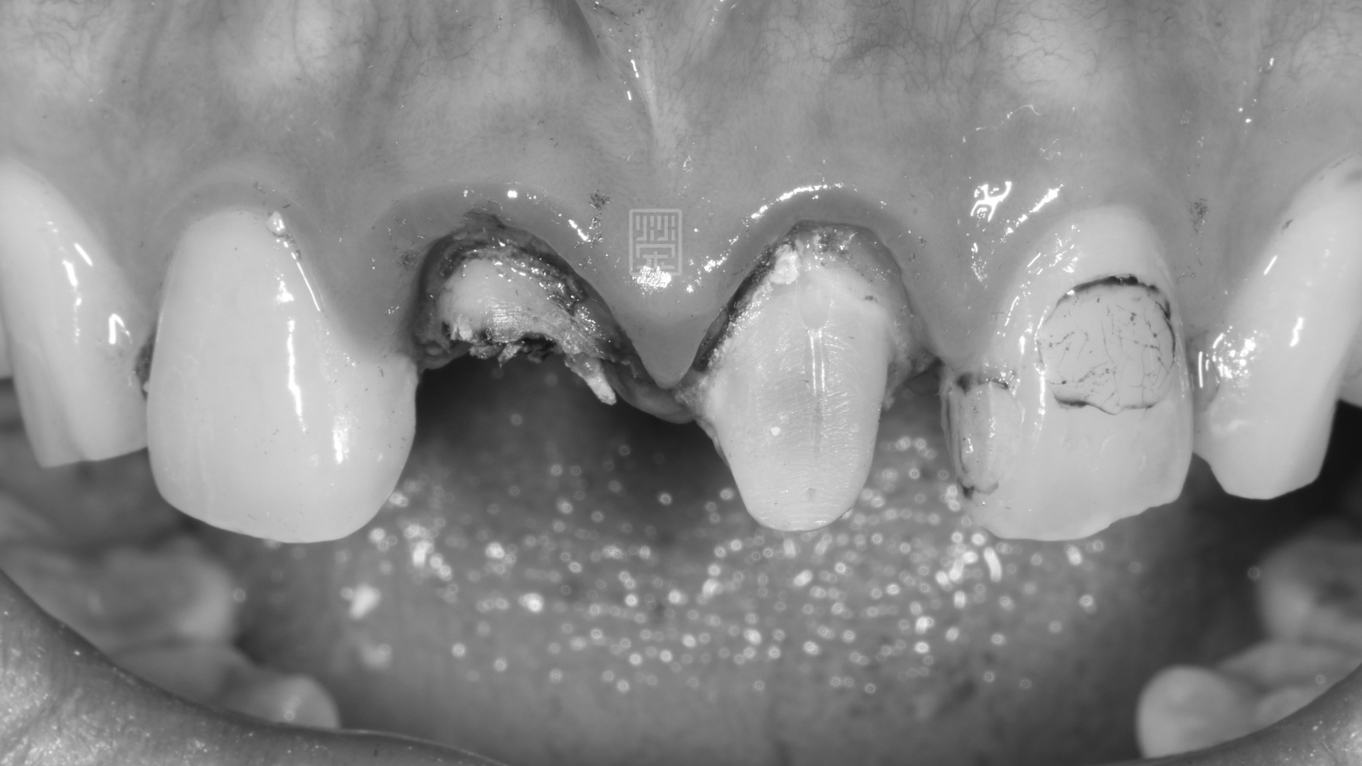 右邊門牙嚴重蛀牙