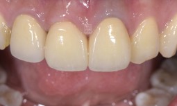 我的牙齒有異味---植牙、全瓷冠修復