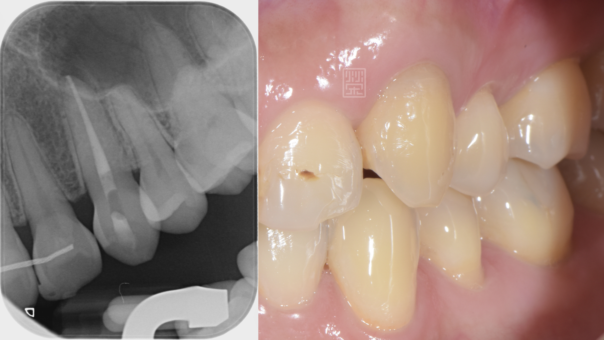 根管治療並且齒內美白