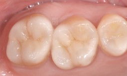 天啊！！我把我的牙齒咬裂了---全瓷嵌體修復