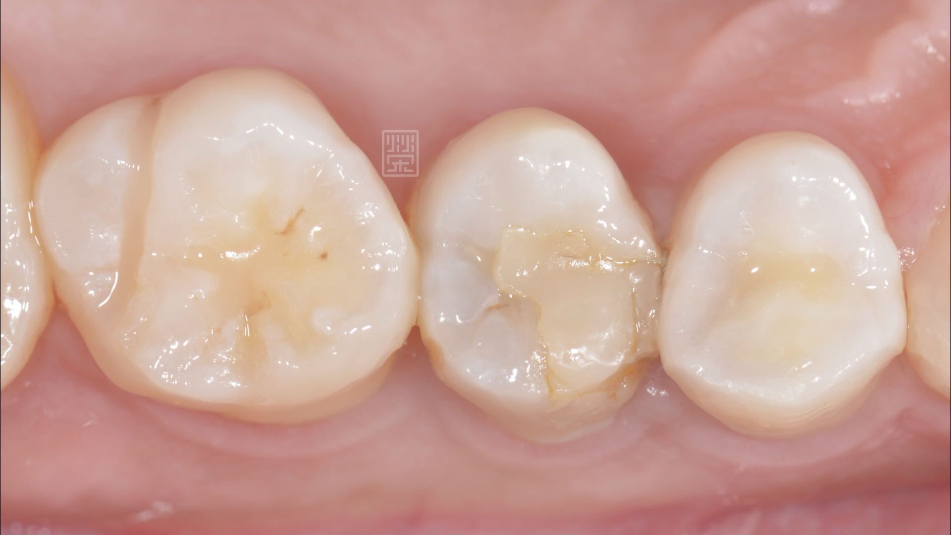 樹脂邊緣有隙縫