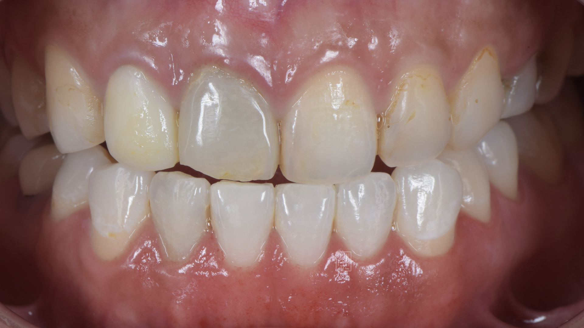 下顎牙齒美白後