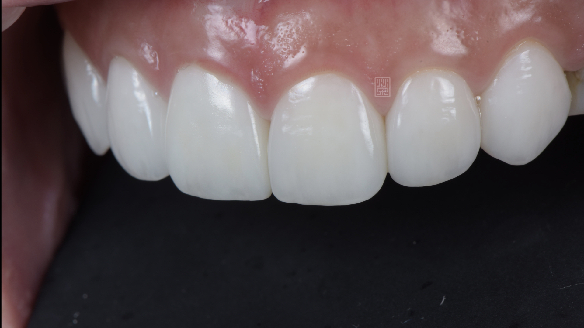 全瓷冠與貼片完成