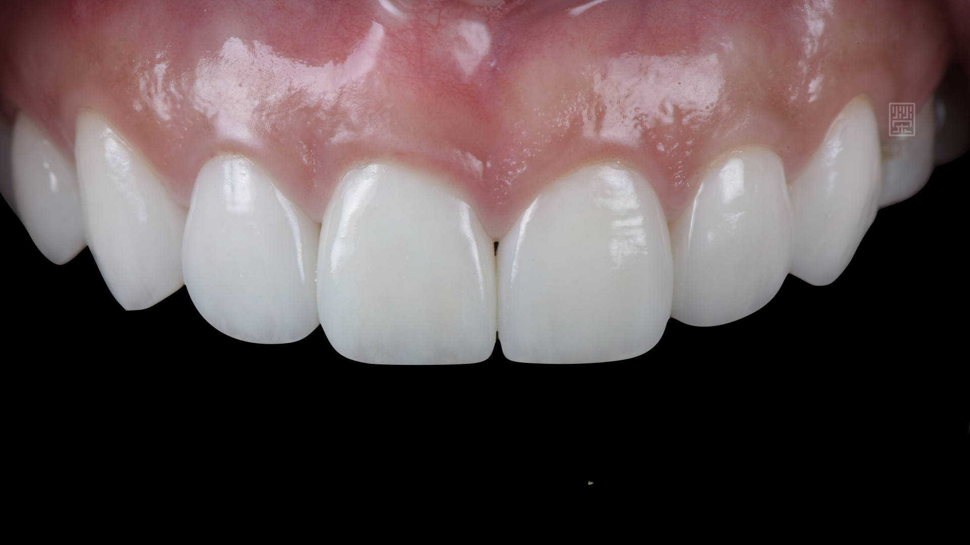 全瓷冠與貼片完成