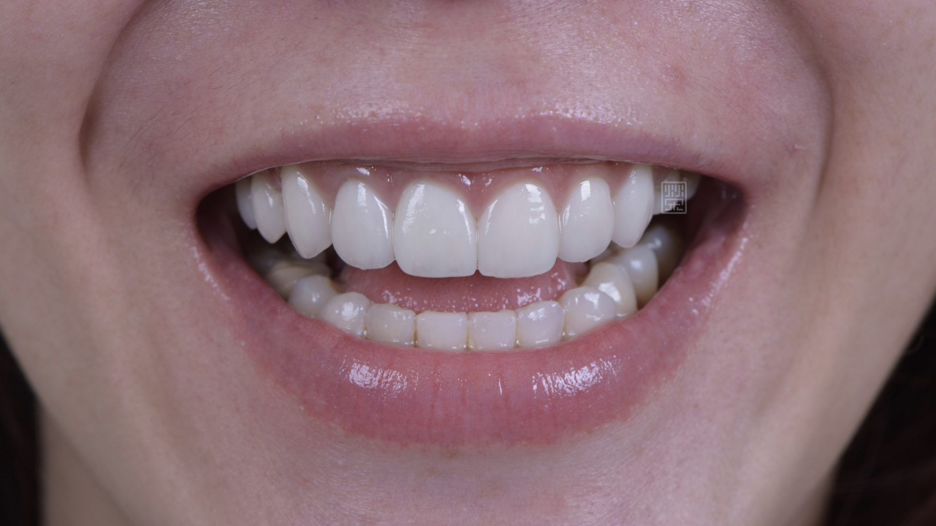 全瓷冠與貼片完成