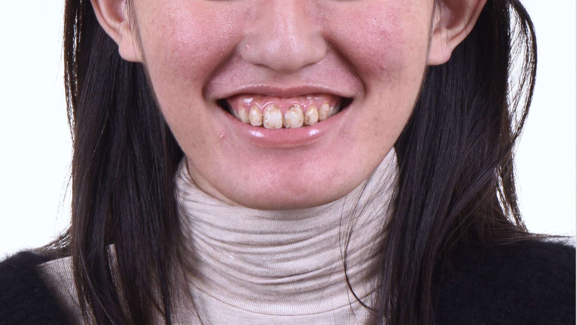 笑齦明顯、尺色偏黃