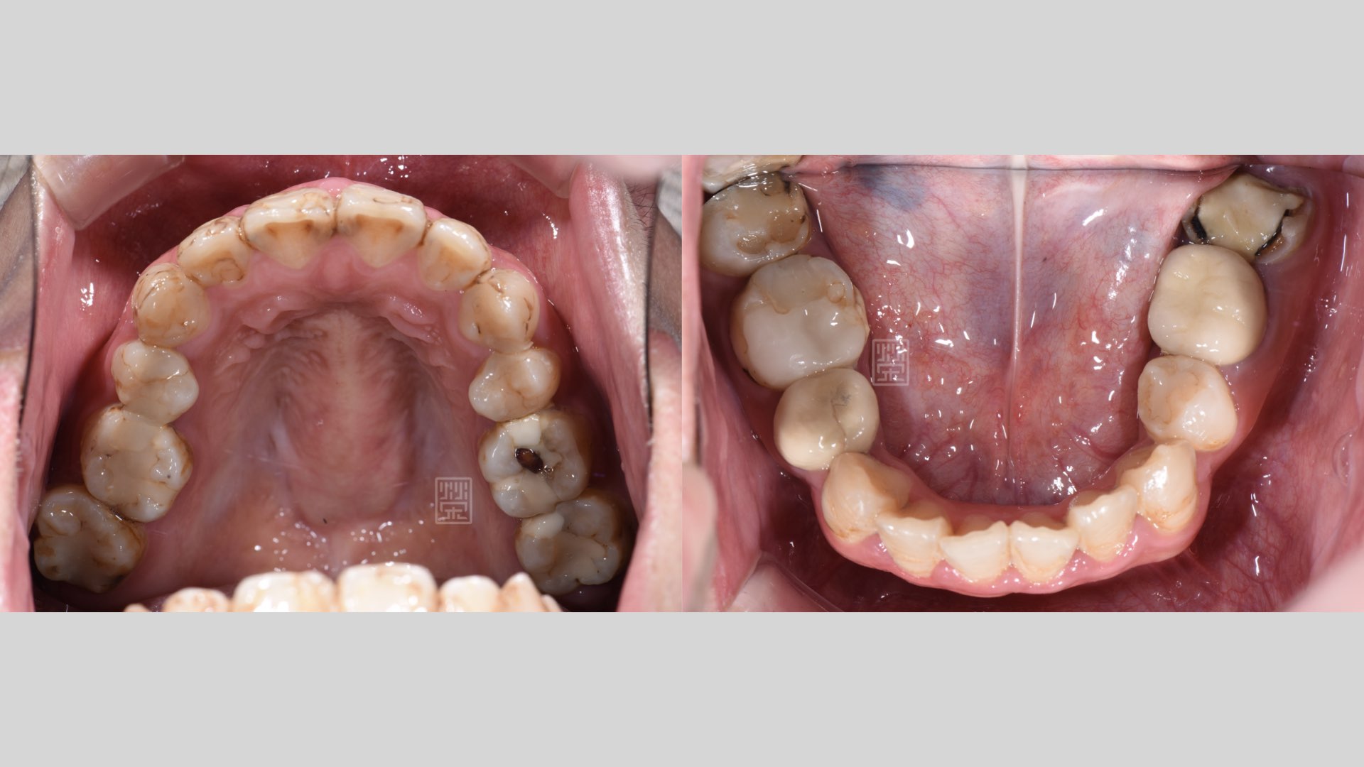 後牙多次蛀牙填補