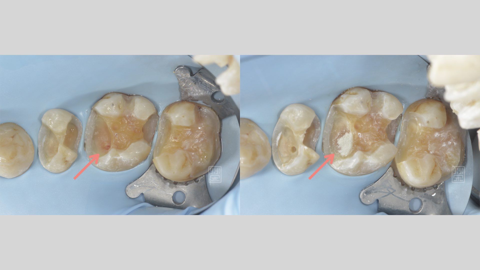 後牙蛀牙清除後，牙髓受感染，ＭＴＡ覆髓治療