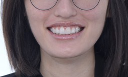 我的牙齒很黃，笑齦很明顯，該怎麼辦呢？------全瓷貼片與全瓷嵌體修復、上唇重置術