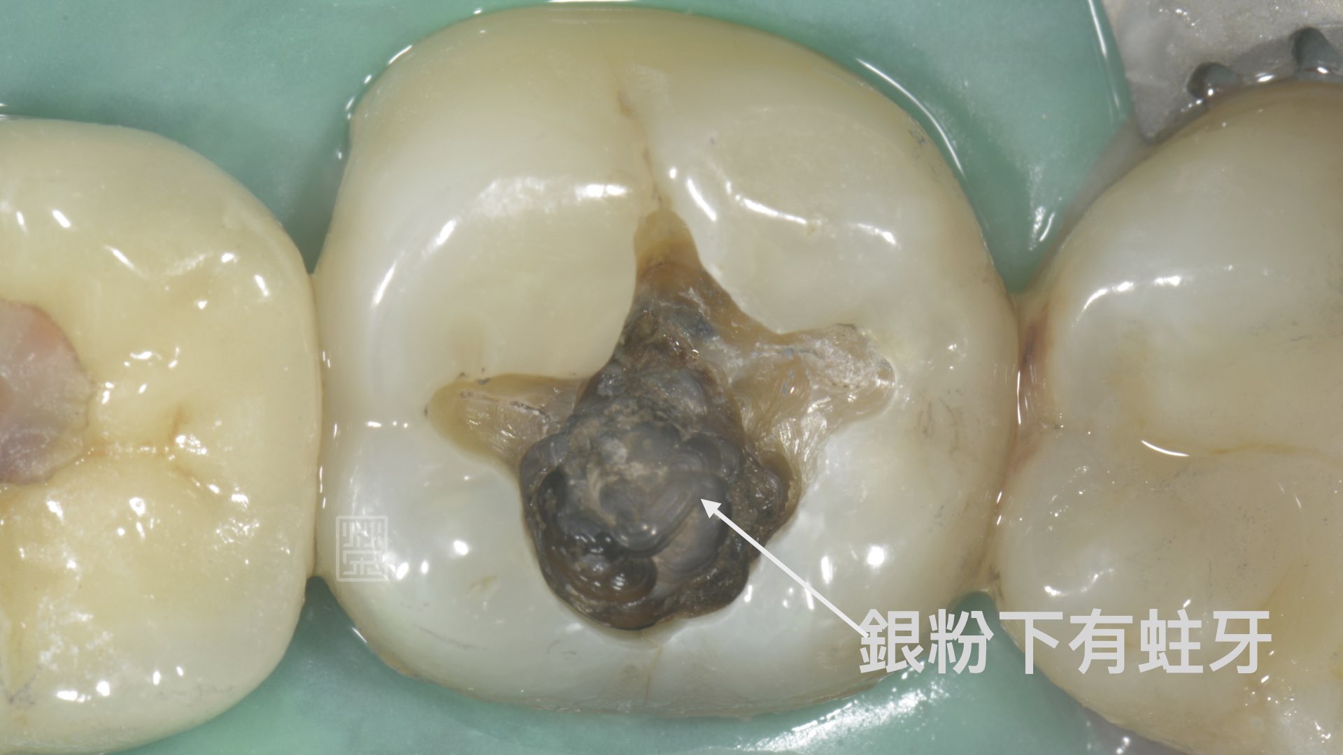銀粉下牙齒蛀牙