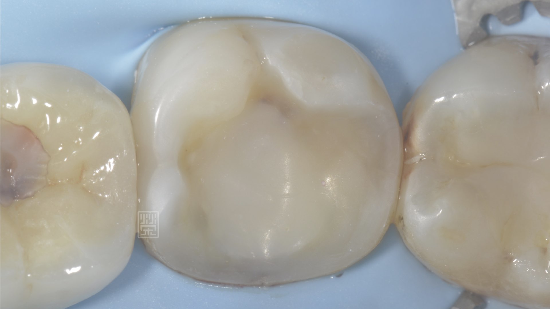 清除蛀牙與裂痕