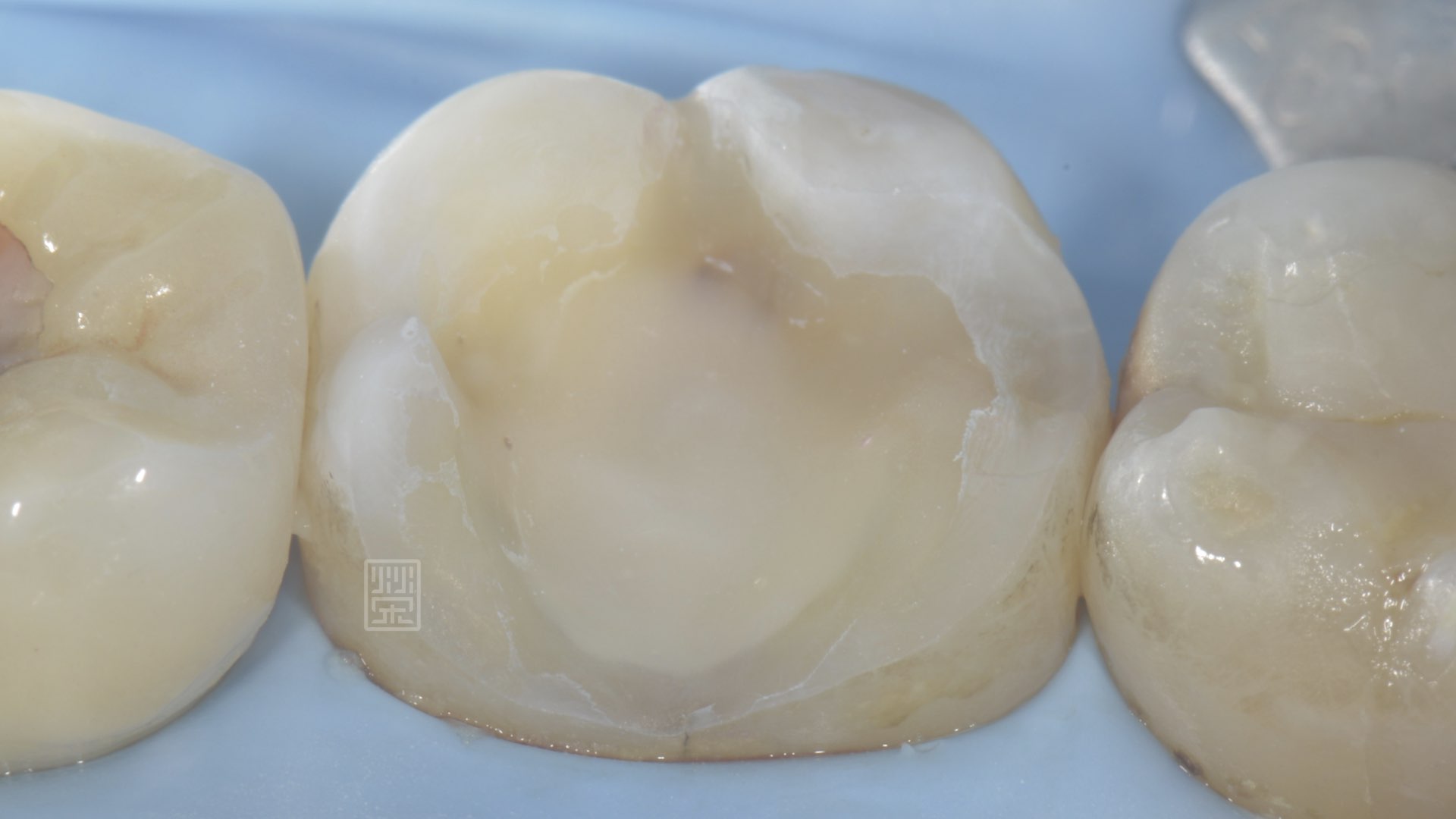 清除蛀牙與裂痕