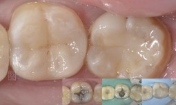 以前補銀粉的牙齒咬起來酸酸的-----牙齒裂了，全瓷嵌體修復