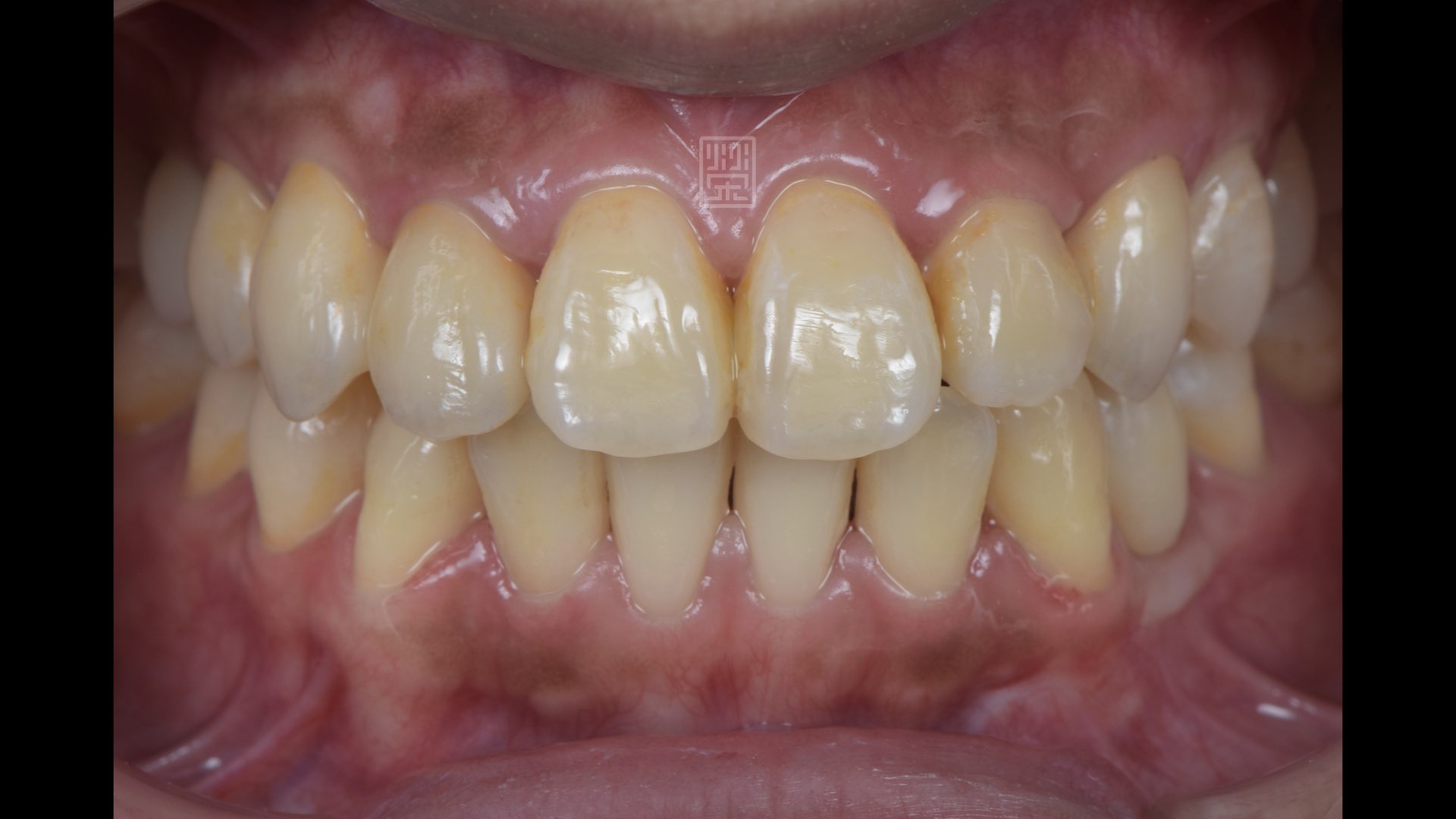 全瓷冠完成，是哪顆呢？