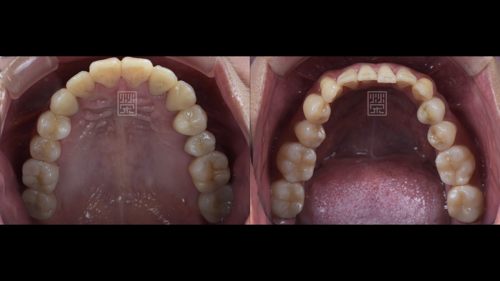 全瓷冠、植牙修復完成