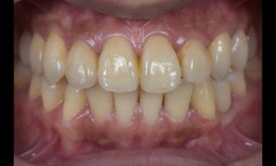 我超怕看牙！！！！---全瓷冠、奈米樹脂、植牙修復