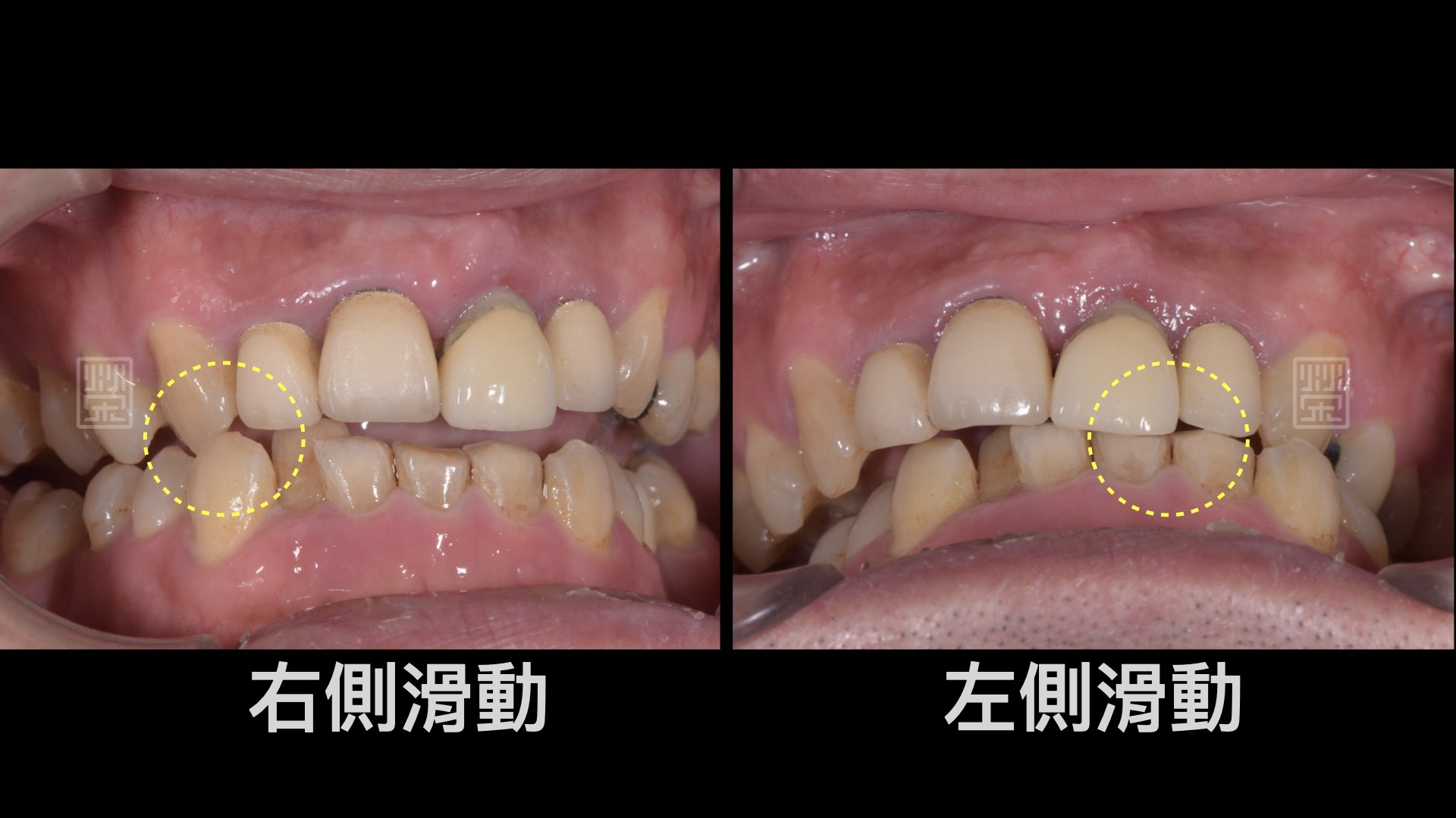 右側運動時，有犬齒導引保護，左側運動時，受力在門齒