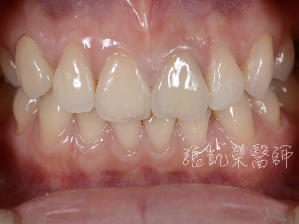 美白、全瓷冠治療後