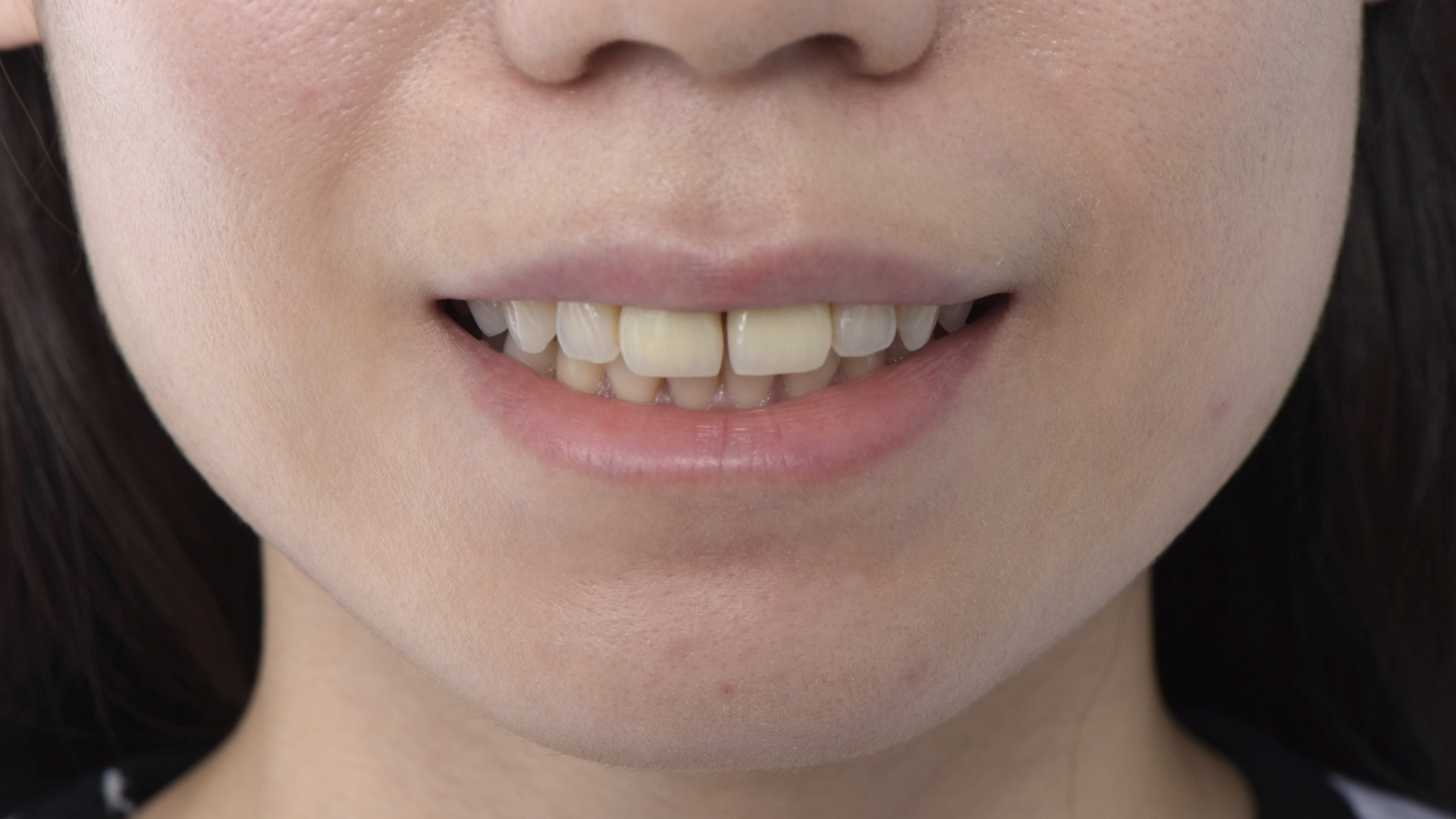 門牙有縫，講話笑起來都很明顯