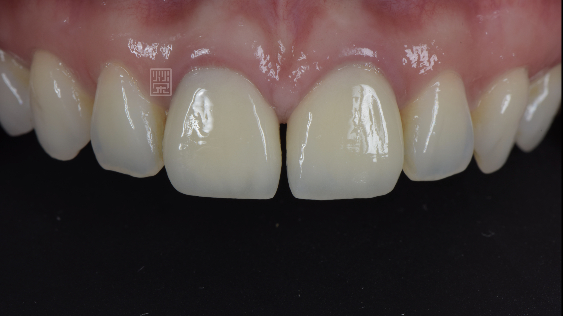 中門牙有縫，牙齦發炎