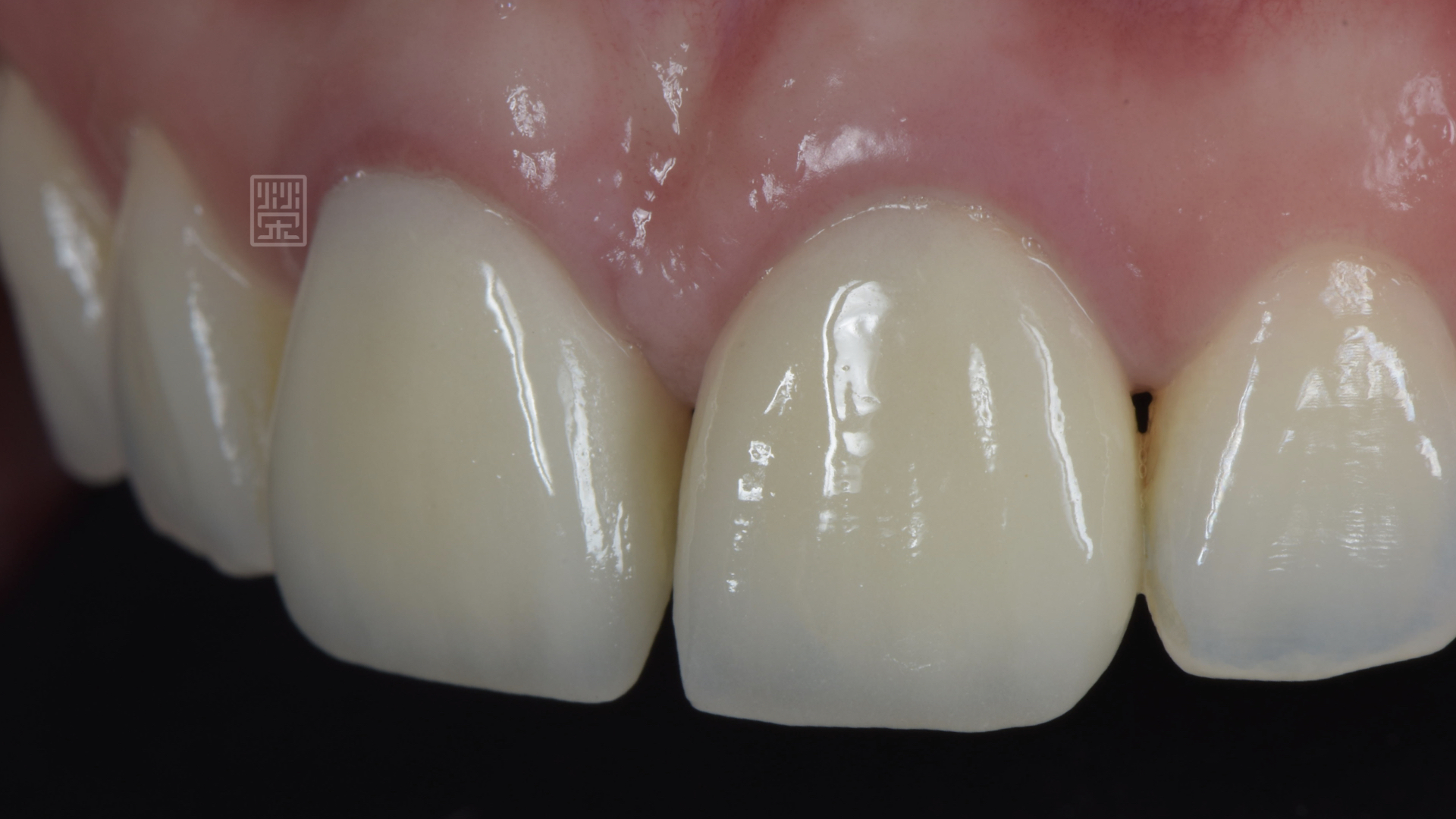 中門牙有縫，牙齦發炎