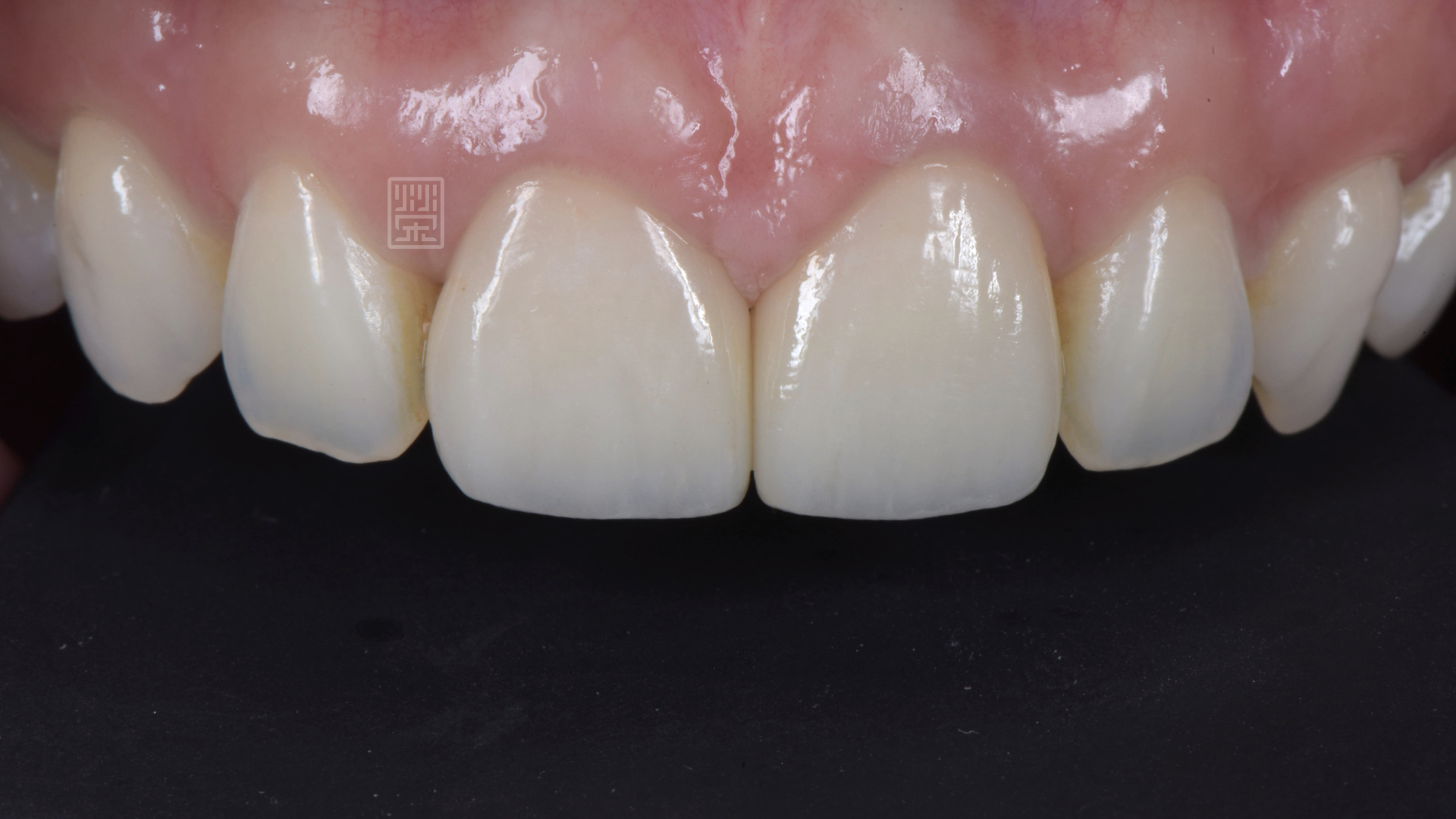 門牙全瓷冠修復，恢復牙齦健康與關閉牙縫