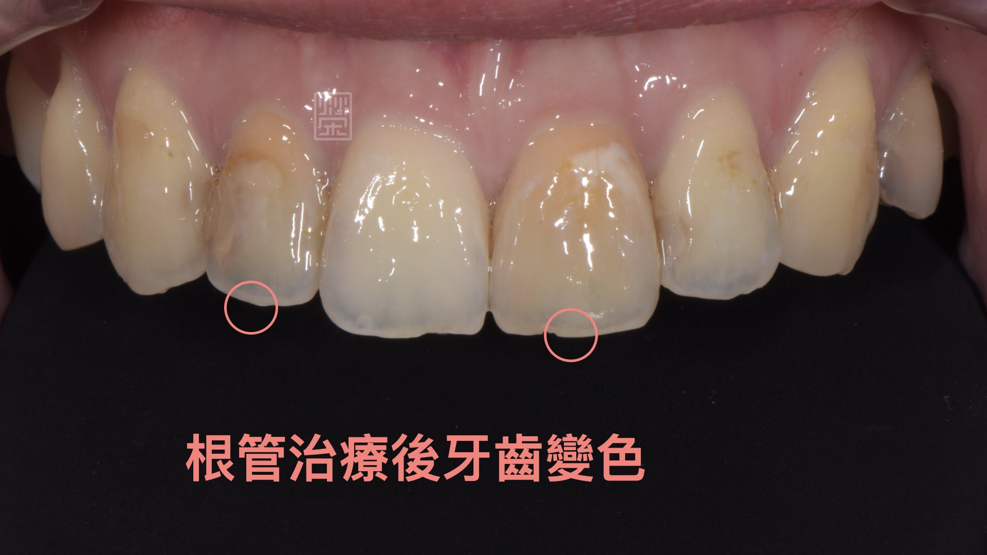 根管治療後牙齒變色