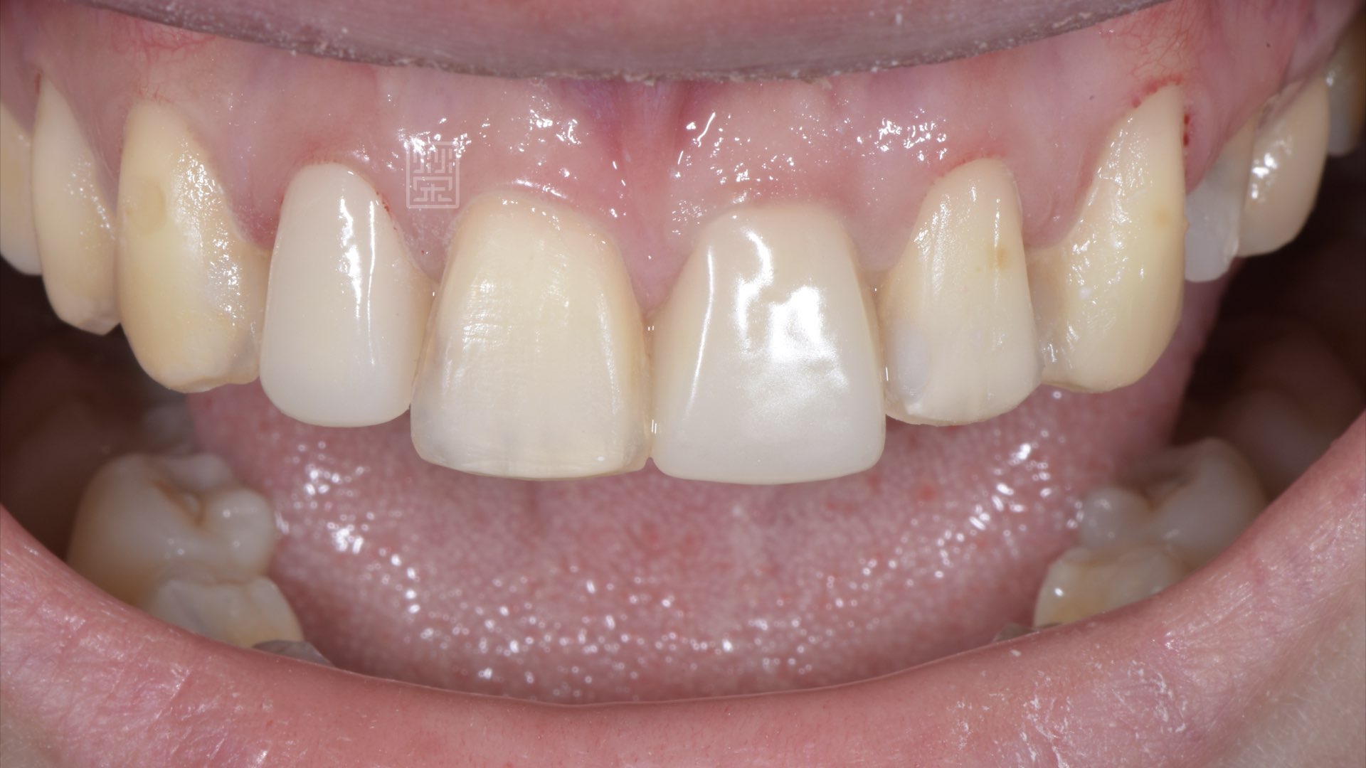 氧化鋯內冠顏色校正