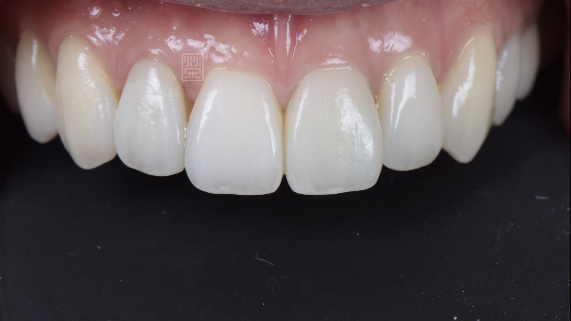 全瓷冠貼片完成