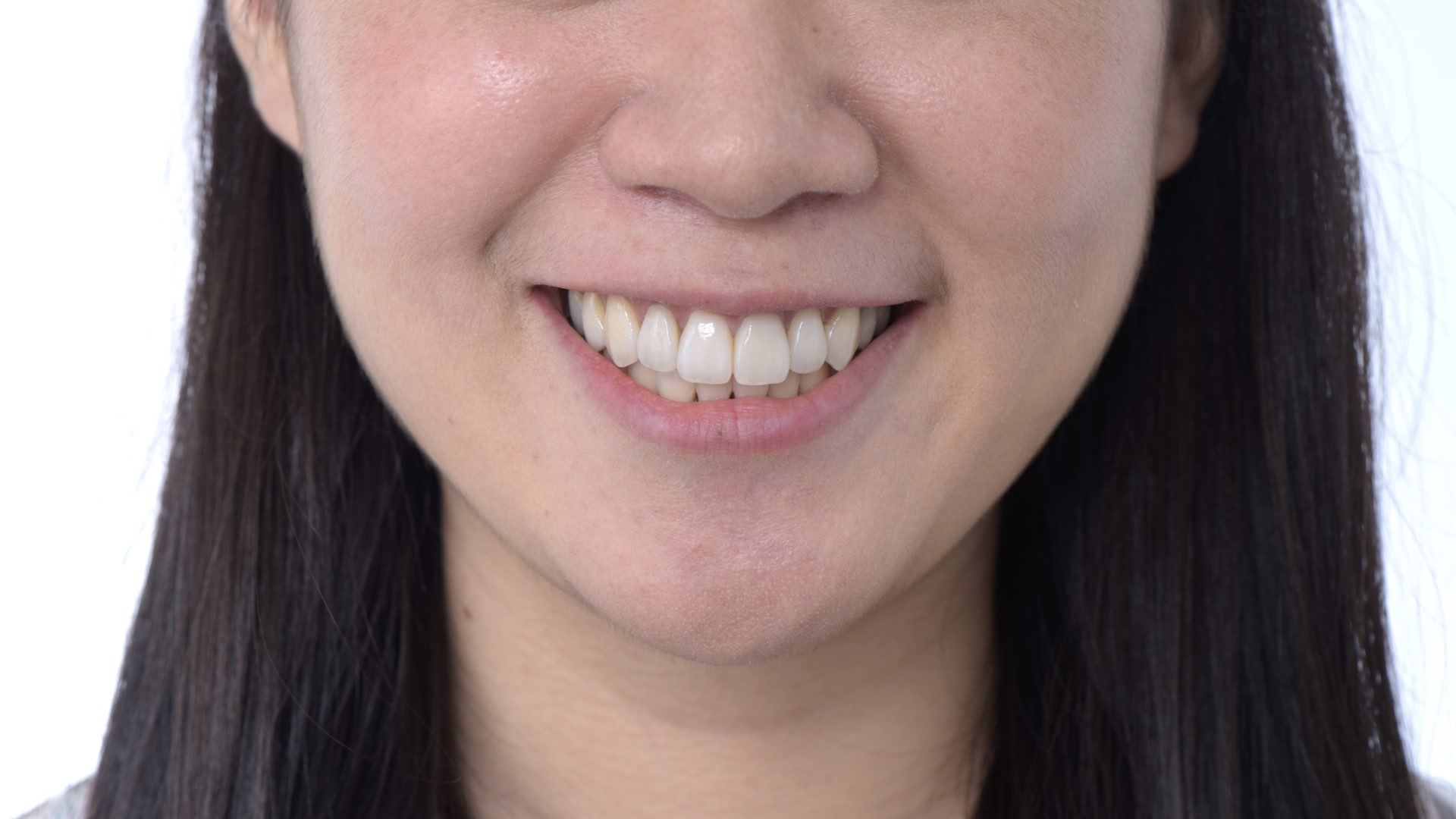 全瓷冠貼片完成