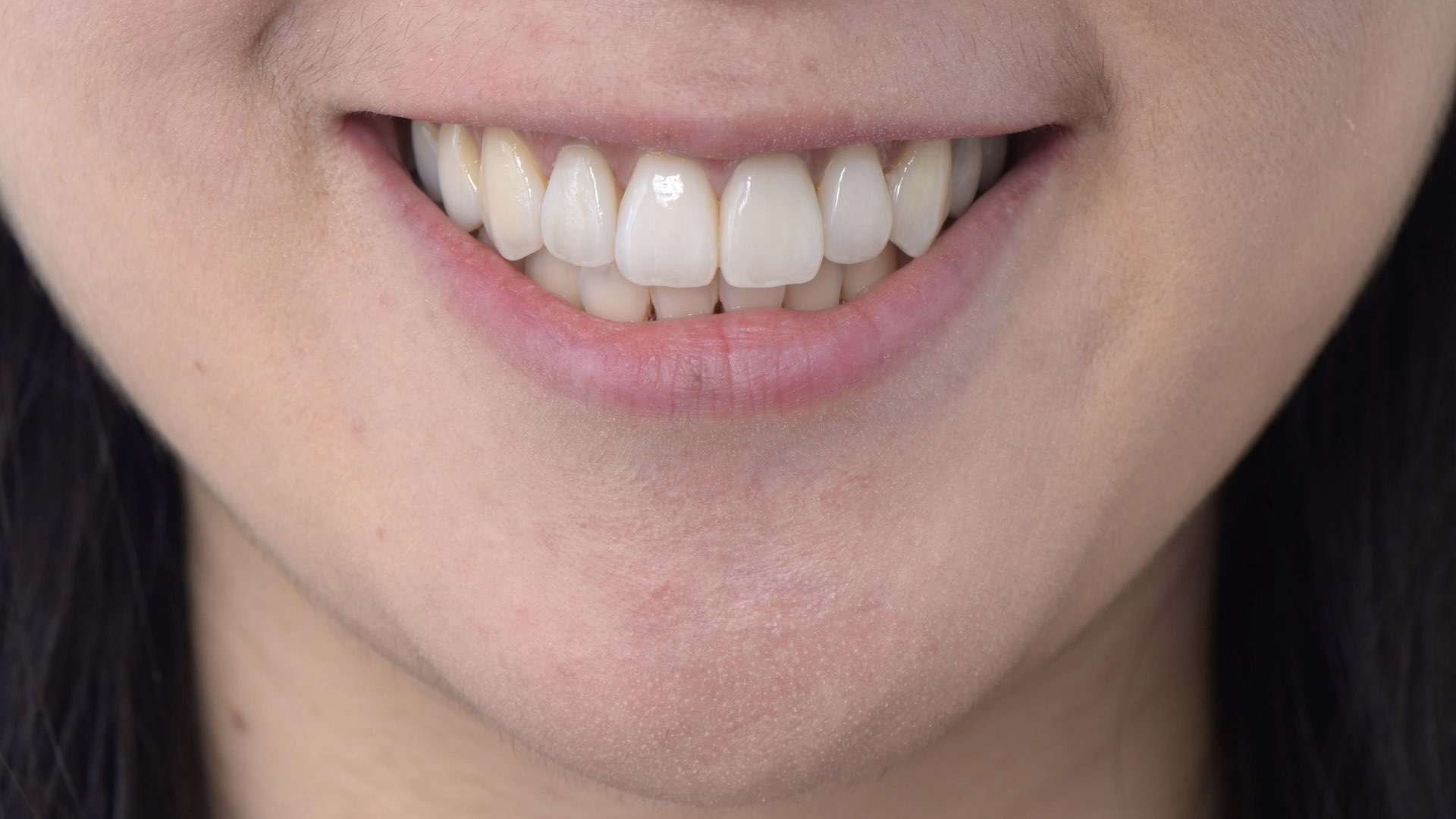 全瓷冠貼片完成