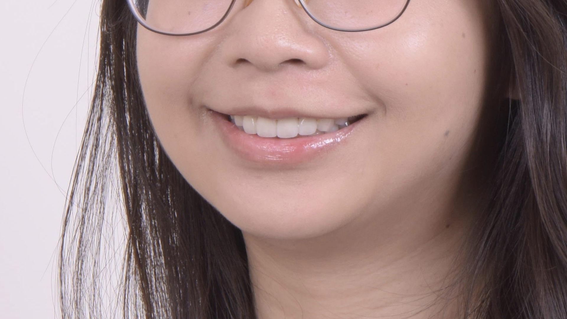 全瓷冠貼片完成